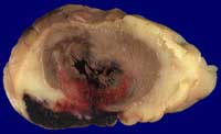 infarctus du myocarde