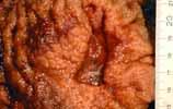 cancer de l'oesophage