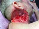 cancer du larynx