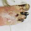 ncrose du pied