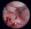 cancer de l'oesophage