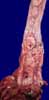 cancer de l'oesophage
