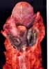 cancer du pharynx