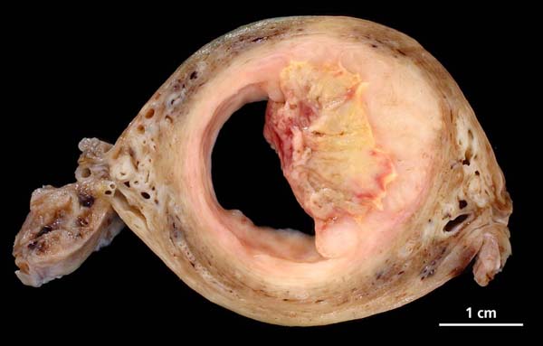 cancer de l'uterus