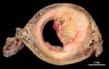 cancer de l'uterus